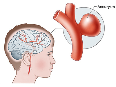Brain Aneurysm blog feature image